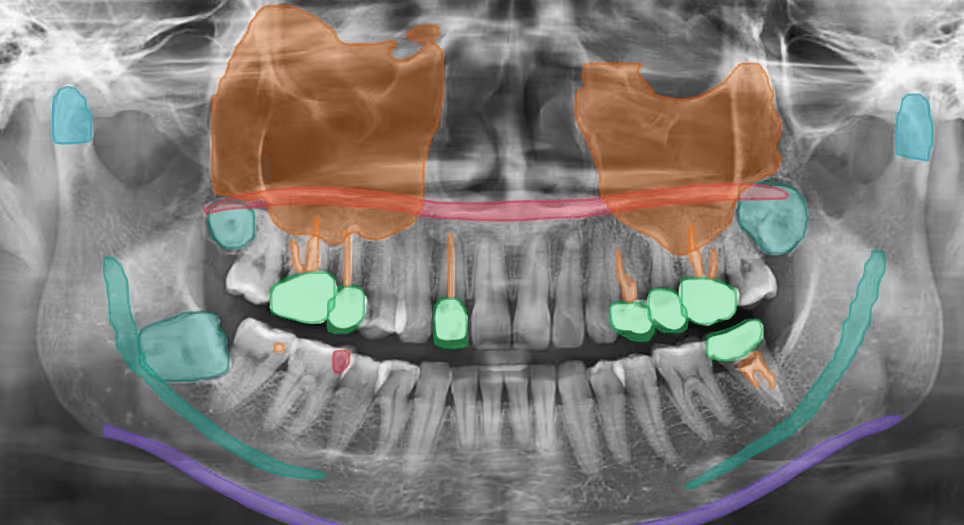 Radiographie panoramique dentaire analysée par l'IA Giantix, zones d'intérêt clinique mises en évidence.